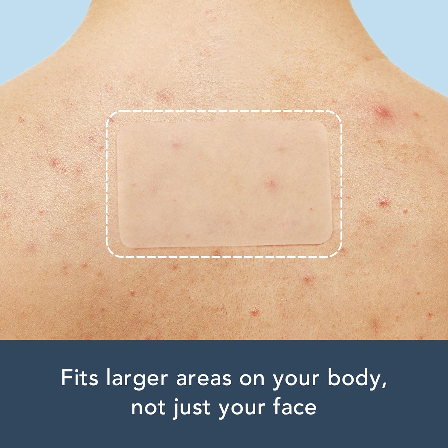 15 large-sized, long acne patc - đánh giá và giá Body Oil